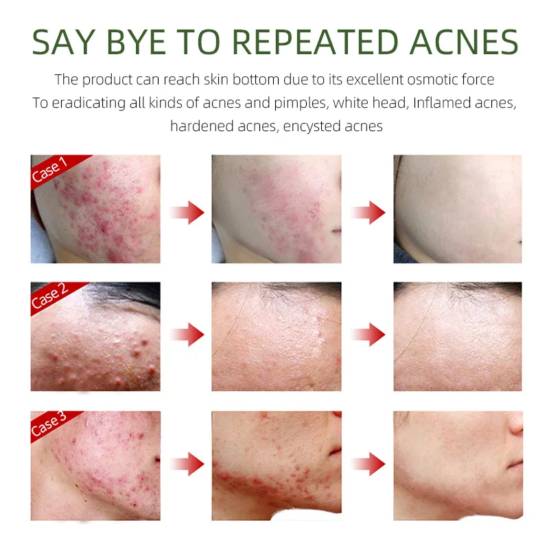 FORT Salicylic Acid Serum – Anti-Acne Face Serum & Dark Spot Correcting Serum for Glowing Skin | Acne Skin Care Products 30ml